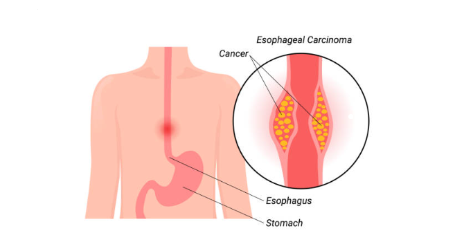 best esophageal cancer surgeon in vashi